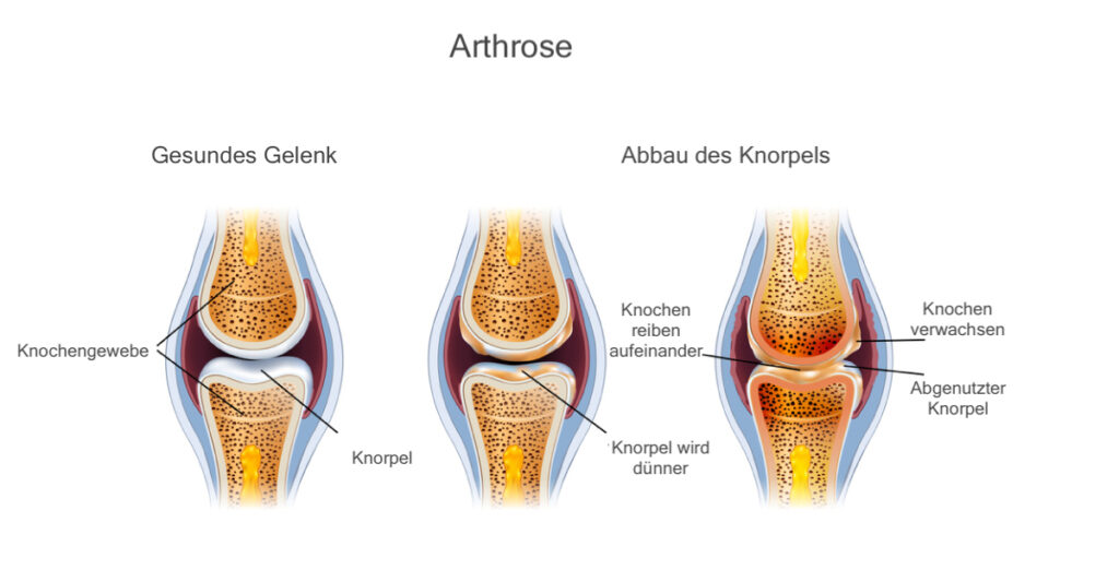 Arthrose-folgen-synopet